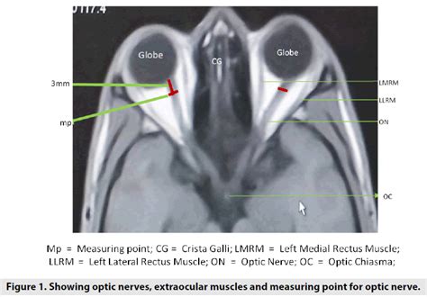 optic nerve thickness measurement mri|normal diameter of optic nerve.